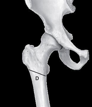 Breuk onder het brede gedeelte van het dijbeen